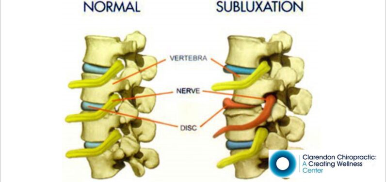 What is Spinal Subluxation?